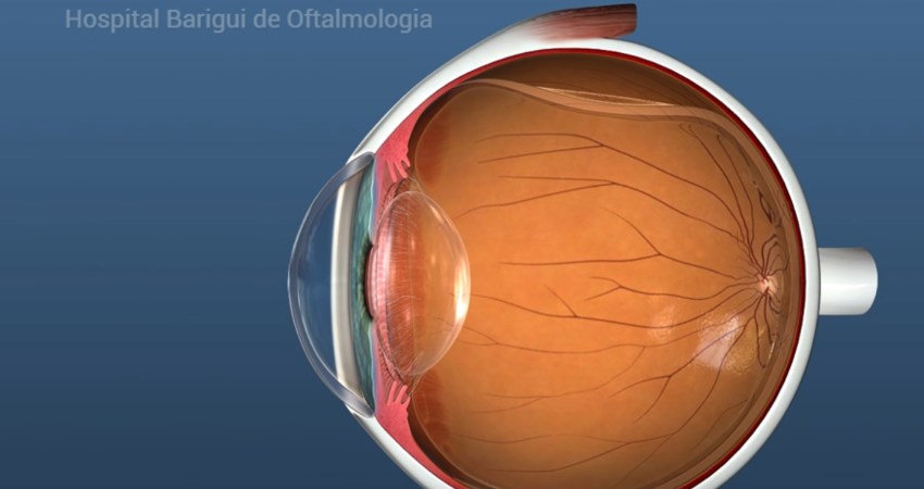 Descolamento da Retina  Oculari Hospital Oftalmológico