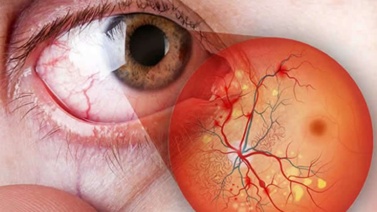 retinopatia diabética curitiba tratamento