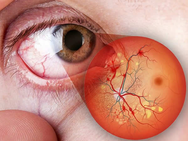 retinopatia diabética curitiba tratamento