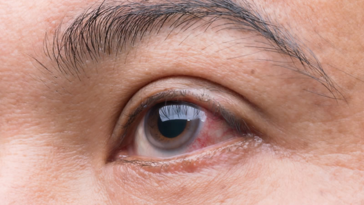 tratamento do glaucoma em curitiba especialista