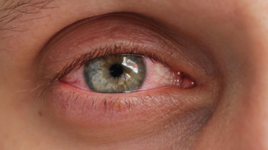 vermelhidão nos olhos causada por lentes de contato