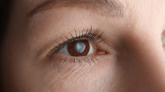 Glaucoma em Curitiba Causas, Sintomas e Prevenção