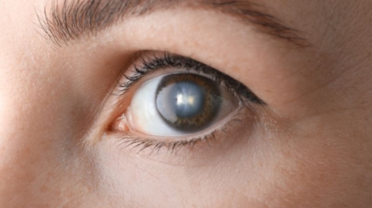 Cirurgia de Catarata em Curitiba com Especialista