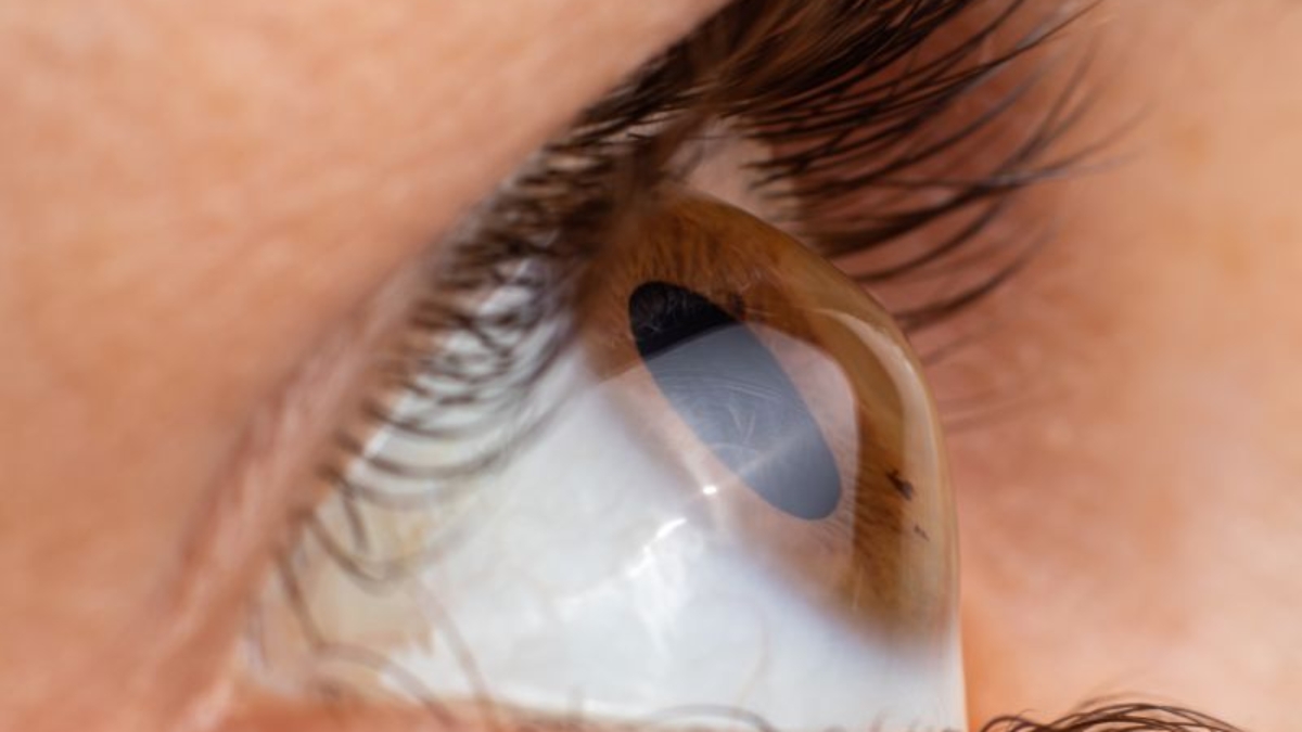 Cirurgia de Ceratocone em Curitiba com Segurança