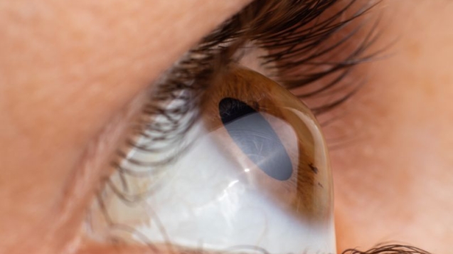 Cirurgia de Ceratocone em Curitiba com Segurança