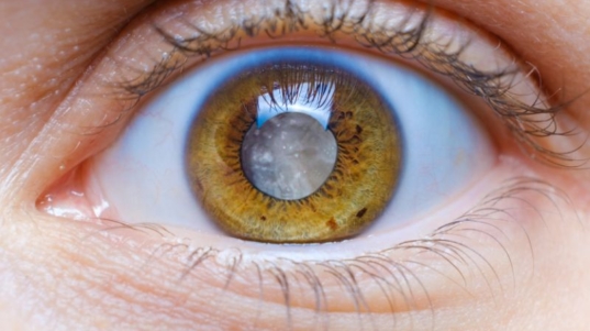 Cirurgia de Glaucoma em Curitiba com Oftalmologista