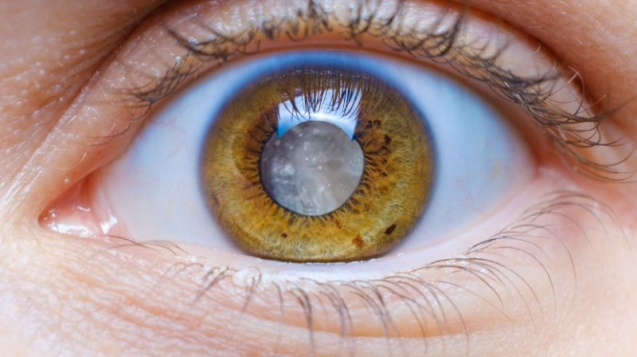 Cirurgia de Glaucoma em Curitiba com Oftalmologista