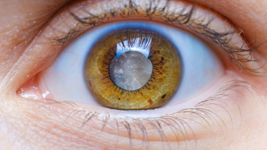 Cirurgia de Glaucoma em Curitiba com Oftalmologista